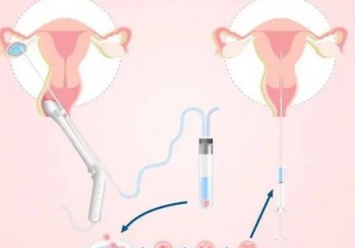温州助孕供卵代怀儿子：﻿窦卵泡的检查时间有讲究，否则检查结果不准确